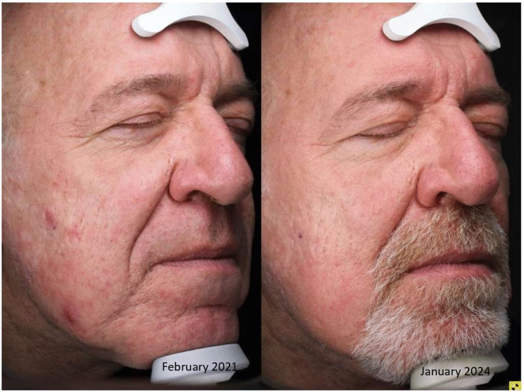 Accure laser akne tedavisi öncesi ve sonrası görünüm